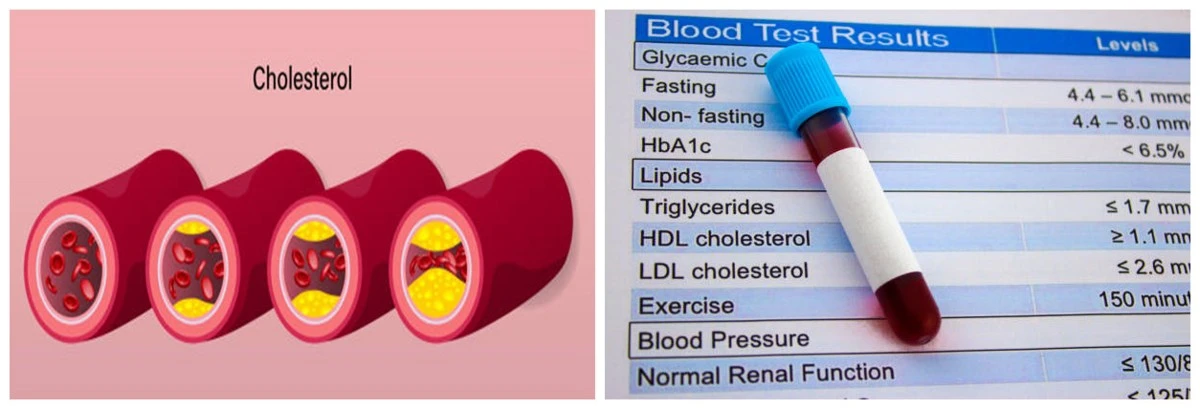 Cholesterol related tests Cholesterol related tests